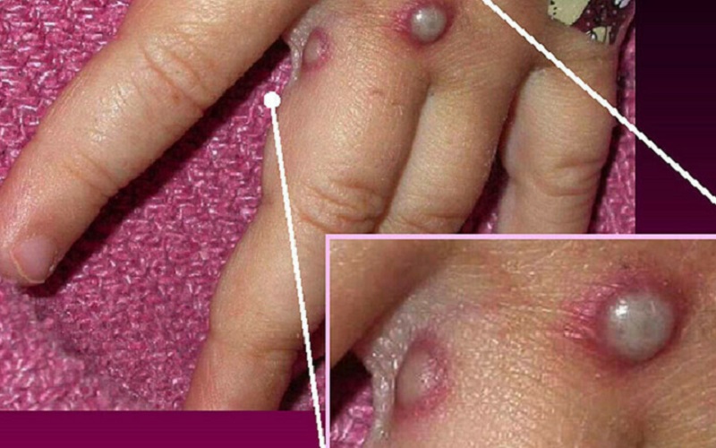 Focar rar și neobișnuit de variolă a maimuței în Regatul Unit, Europa și S.U.A. Ce este și de ce ar trebui să ne facem griji