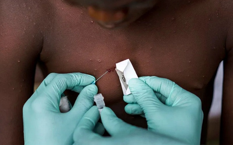 Variola maimuței// OMS a emis definițiile de caz confirmat și suspect. Ce soluții de tratament există în lume pentru această infecție