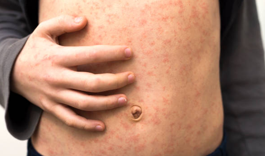 Un nou focar de rujeolă a fost confirmat. 5 copii dintr-o familie din Chișinău au ajuns în atenția medicilor