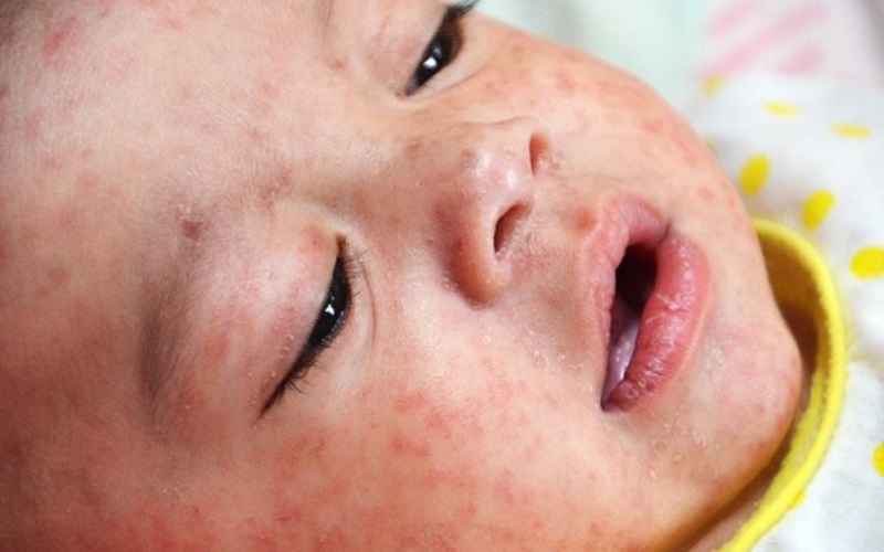 Numărul cazurilor de rujeolă a trecut de 10.000. Doar în ultima săptămână în România s-au înregistrat peste 100 de îmbolnăviri 