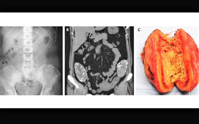 Iată ce se întâmplă când lăsați bureți chirurgicali în corpul unei persoane timp de mai mulți ani