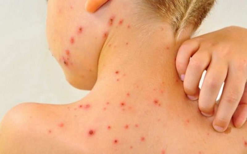 Situație alarmantă în Ucraina și România privind rujeola. Medicii recomandă părinților să nu întârzie vaccinarea