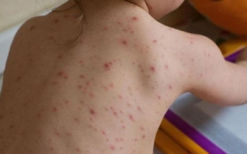 Un copil nevaccinat poate infecta de rujeolă alți 18. În Moldova sunt deja peste 60 de cazuri confirmate, iar toamna numărul riscă să crească, deoarece se redeschid școlile și grădinițele