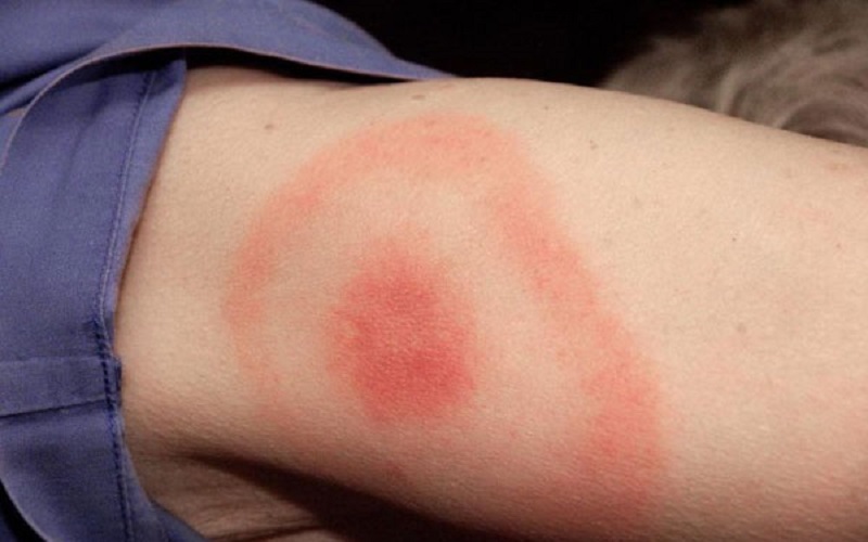 Crește numărul moldovenilor diagnosticați cu boala Lyme, transmisă de căpușe