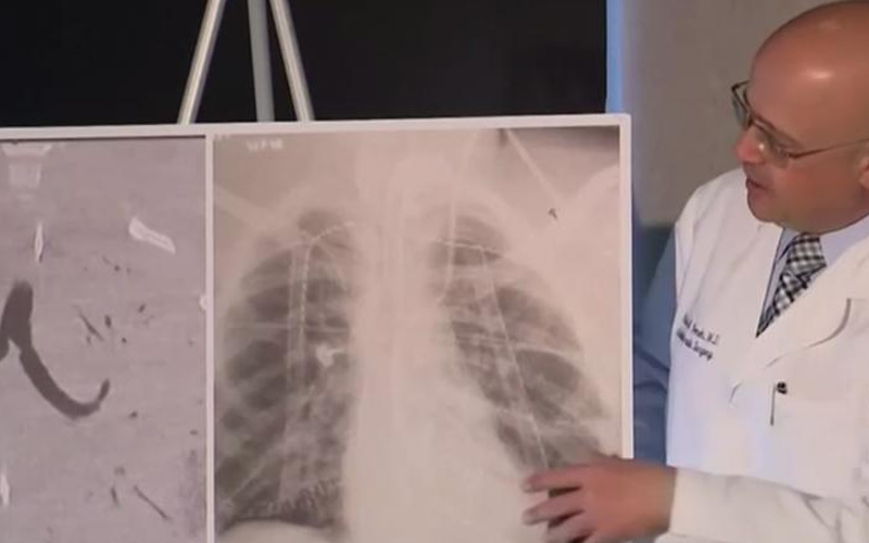 Un adolescent credea că are pneumonie, însă a avut nevoie de dublu transplant de plămâni. Medic: Nu am mai văzut așa ceva