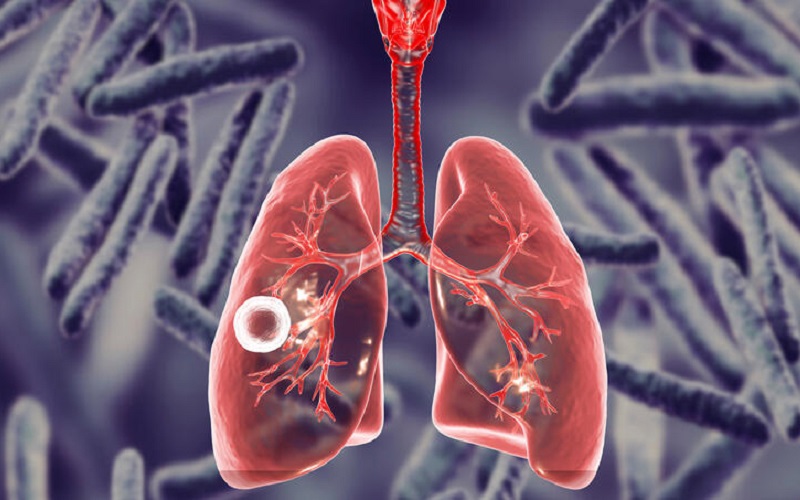 Din cauza pandemiei Covid-19, numărul persoanelor care au beneficiat de îngrijire în TB a scăzut cu 1,4 milioane. „Este nevoie urgent de a reporni efortul global de a pune capăt tuberculozei”