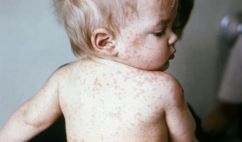 Șapte cazuri de rujeolă confirmate la Centrul de plasament al refugiaților din Ucraina din Capitală, iar România înregistrează al 9-lea deces provocat de rujeolă