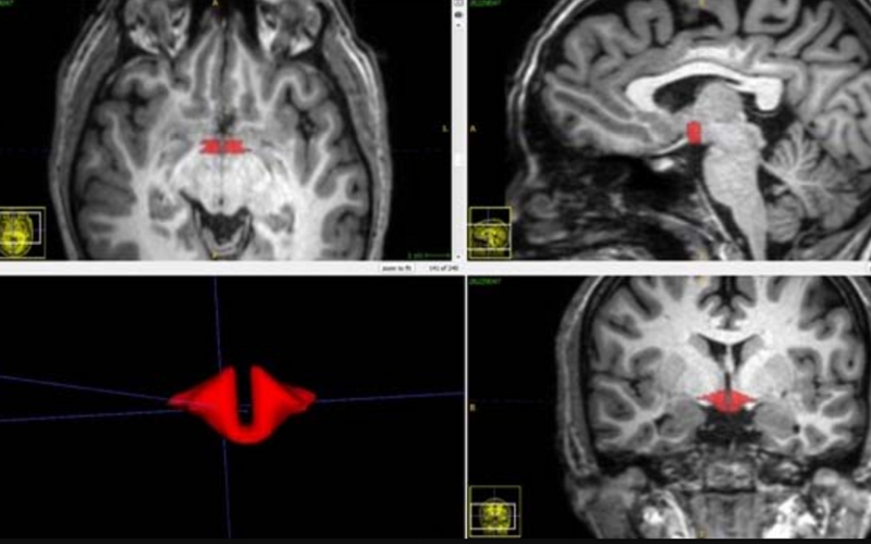 Studiu controversat: femeile care iau contraceptive au o parte a creierului mai mică 