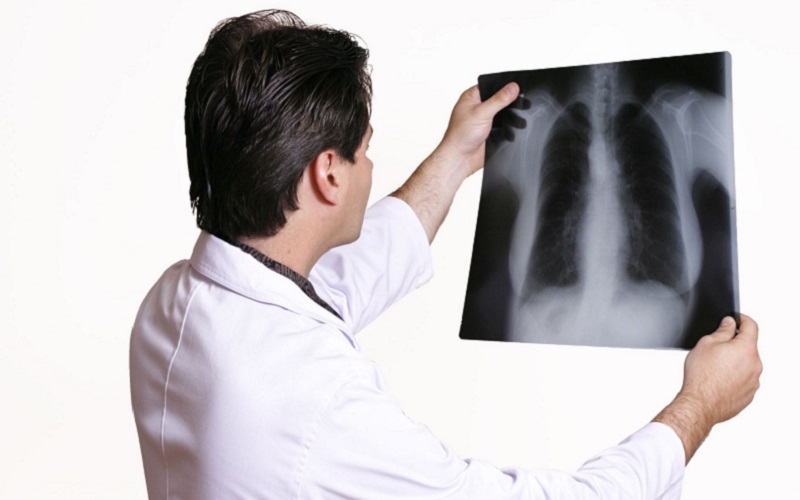 În premieră pentru Moldova, CNAM finanțează proiecte de prevenire și control a tuberculozei. Până când este deschis concursul și câți bani se oferă